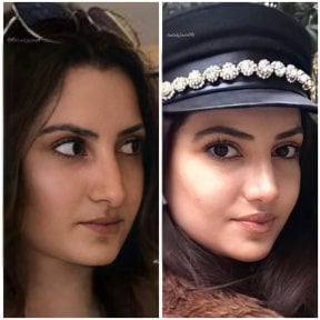 before-after photo rhinoplasty-nose-job