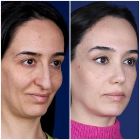 before-after photo rhinoplasty-nose-job