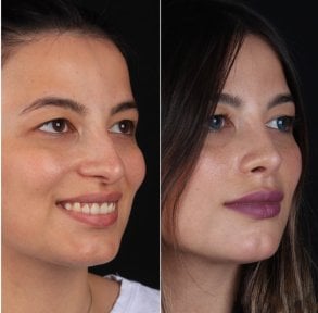 before-after photo rhinoplasty-nose-job