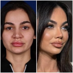 before-after photo rhinoplasty-nose-job