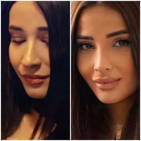 before-after photo rhinoplasty-nose-job