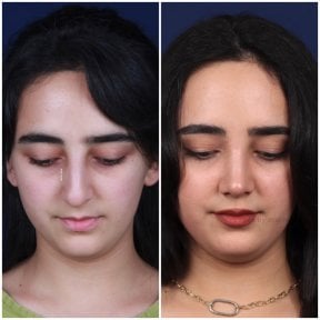 before-after photo rhinoplasty-nose-job
