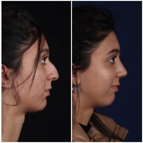 before-after photo rhinoplasty-nose-job