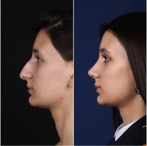 before-after photo rhinoplasty-nose-job