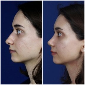before-after photo rhinoplasty-nose-job