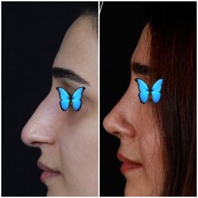 before-after photo rhinoplasty-nose-job