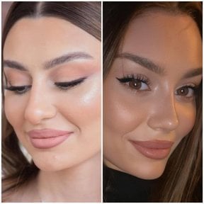 before-after photo rhinoplasty-nose-job