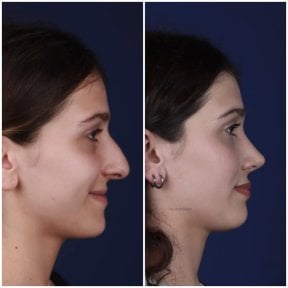 before-after photo rhinoplasty-nose-job