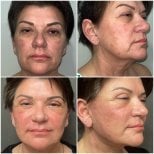 Before and after facelift results at Soraca Med – visible facial rejuvenation and skin tightening