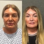 Resultados de lifting facial antes y después en Soraca Med – rejuvenecimiento visible