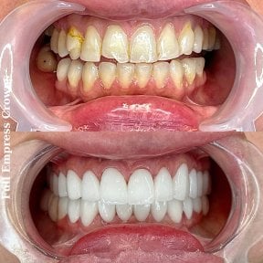 Resultados antes y después de coronas Empress completas – renovación de sonrisa