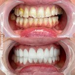 Resultados antes y después de coronas Empress completas – renovación de sonrisa