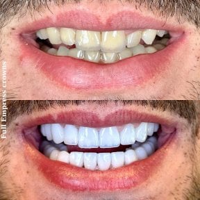 Resultados antes y después de coronas dentales Full Empress: sonrisa mejorada