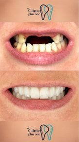 Resultados de implantes dentales antes y después en Clinic Plus One – sonrisa restaurada