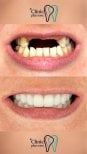 Resultados de implantes dentales antes y después en Clinic Plus One – sonrisa restaurada
