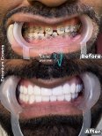 Antes y después de coronas de zirconio en Clinic Plus One: resultado de sonrisa