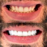 Resultado antes y después de carillas: sonrisa mejorada y dientes más blancos