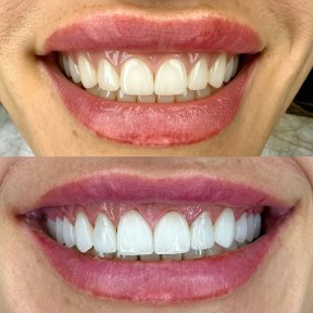 Resultados antes y después de coronas dentales: mejora estética de la sonrisa y forma dental