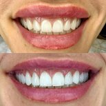 Resultados antes y después de coronas dentales: mejora estética de la sonrisa y forma dental