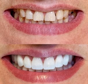 До і після Hollywood Smile – вініри для білих і рівних зубів, помітний результат