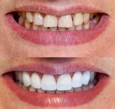 До і після Hollywood Smile – вініри для білих і рівних зубів, помітний результат