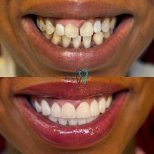 Smile makeover before and after results at Clinic Plus One – dental veneers for perfect teeth