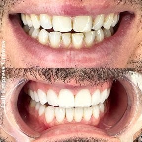 Before and after Hollywood Smile with full Empress crowns, visible smile transformation result