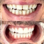 Before and after Hollywood Smile with full Empress crowns, visible smile transformation result