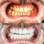 Before and after Emax crowns result – Hollywood Smile transformation with whiter teeth