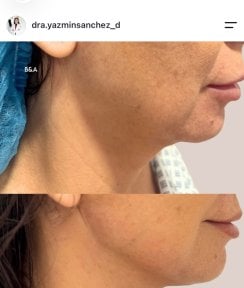 before-after photo tightening-of-facial-skin-facelift