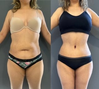 before-after photo abdominoplasty