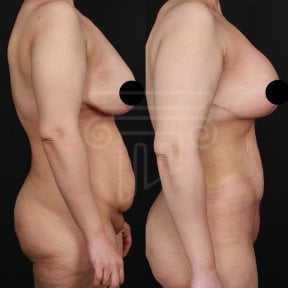 Résultats avant/après abdominoplastie à la clinique Dr. Safa Manav, ventre raffermi