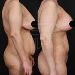 Résultats avant/après abdominoplastie à la clinique Dr. Safa Manav, ventre raffermi