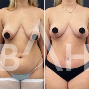 Результаты до и после подтяжки груди в Büyük Anadolu Hospitals (BAH International), улучшенный контур