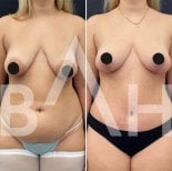 Результаты до и после подтяжки груди в Büyük Anadolu Hospitals (BAH International), улучшенный контур