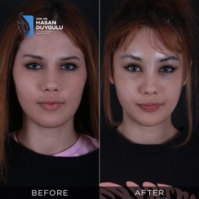Resultados antes y después de Fox Eye Lift en Dr. Hasan Duygulu - Face Aesthetics Turkey