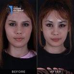Resultados antes y después de Fox Eye Lift en Dr. Hasan Duygulu - Face Aesthetics Turkey