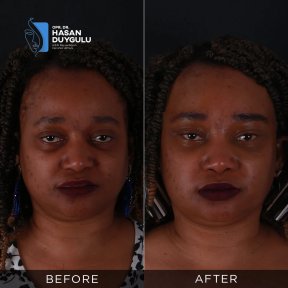 Resultados antes y después de Fox Eye Lift en Dr. Hasan Duygulu - Face Aesthetics Clinic Turquía