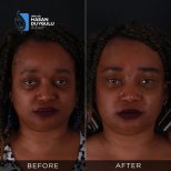 Resultados antes y después de Fox Eye Lift en Dr. Hasan Duygulu - Face Aesthetics Clinic Turquía