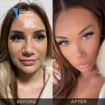 Resultados antes y después de Fox Eye Lift en Dr. Hasan Duygulu - Face Aesthetics Turkey