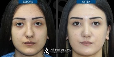 Результаты ринопластики до и после в клинике Dr. Safa Manav, коррекция носа для женщин