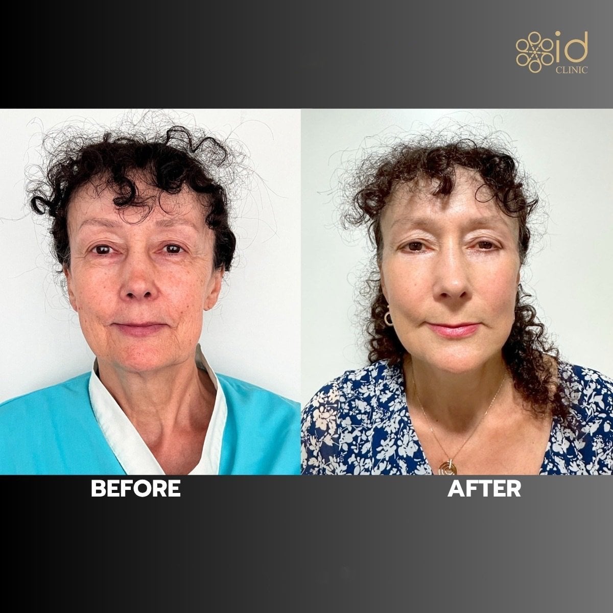 Resultados de minilifting facial antes y después en ID Clinic Bangkok, rejuvenecimiento visible