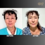 Before and after mini facelift results at ID Clinic Bangkok, visible facial rejuvenation