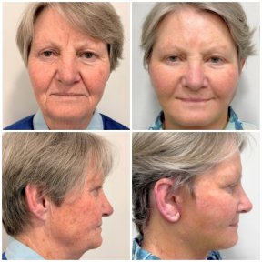 Résultats avant et après mini lifting du visage à ID Clinic Bangkok, rajeunissement visible
