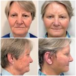 Résultats avant et après mini lifting du visage à ID Clinic Bangkok, rajeunissement visible