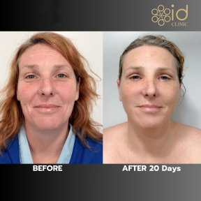 Before and after mini facelift results at ID Clinic Bangkok, visible facial rejuvenation after 20 days