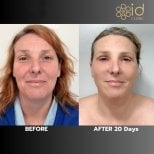 Before and after mini facelift results at ID Clinic Bangkok, visible facial rejuvenation after 20 days