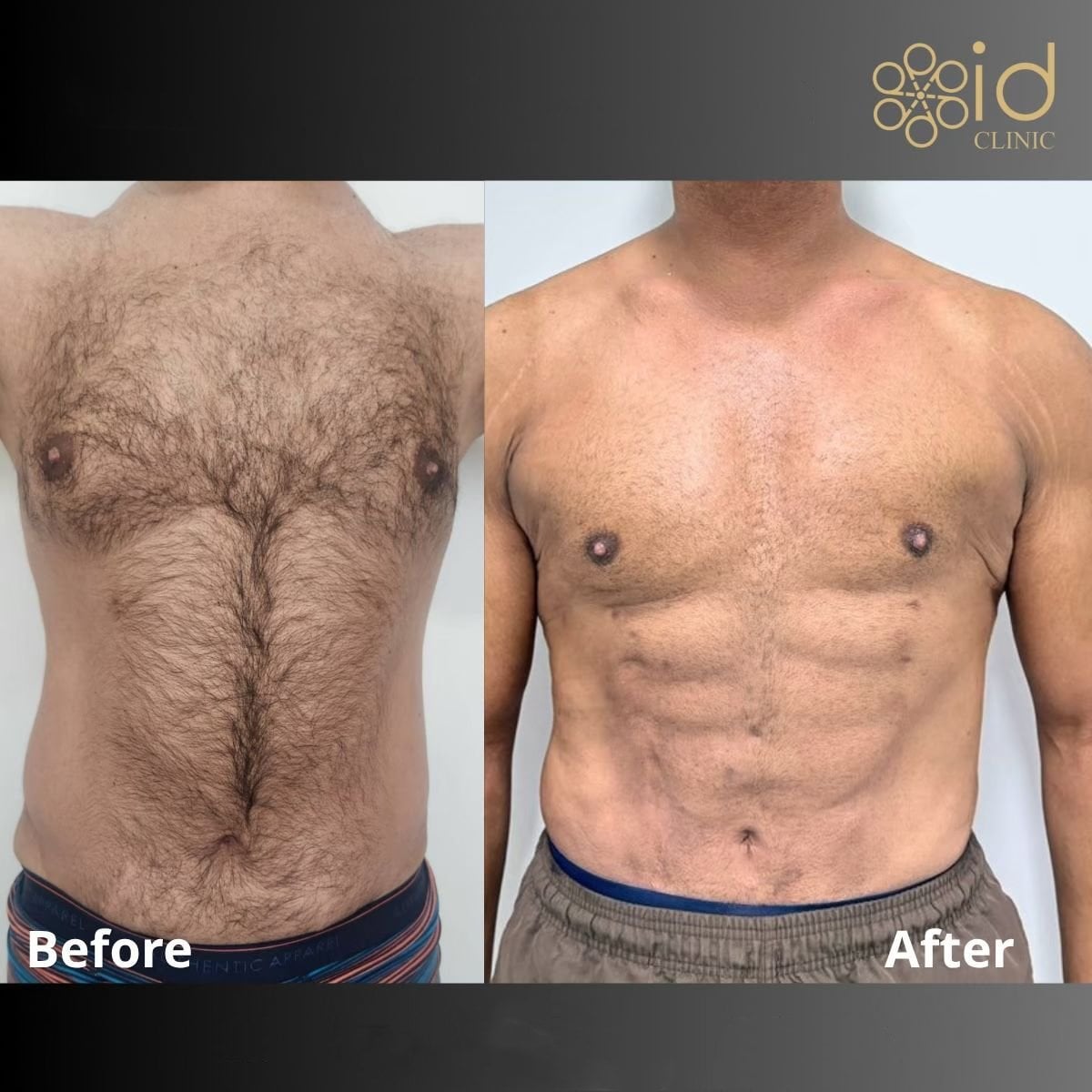 Resultados antes y después de abdominal etching (six pack abs) en ID Clinic Bangkok
