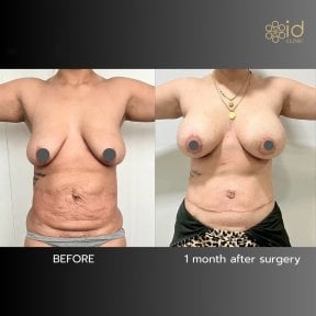 Результаты до и после mommy makeover в ID Clinic Bangkok – улучшение контуров тела