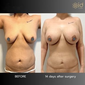 Efekty przed i po mommy makeover w ID Clinic Bangkok – modelowanie piersi i brzucha